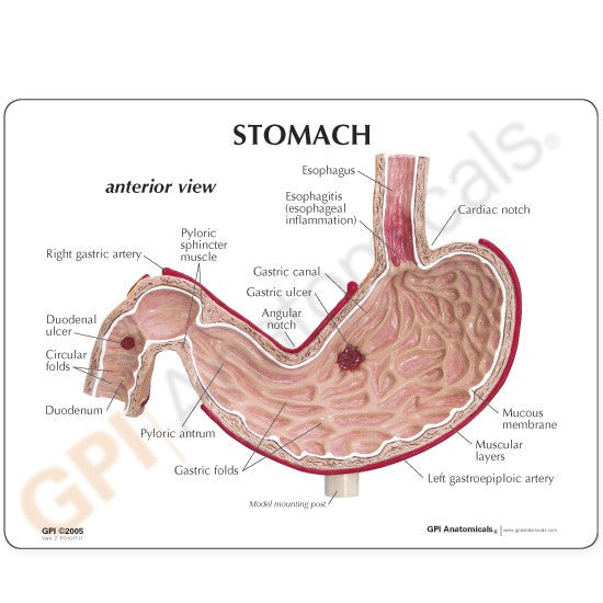 Stomach Ulcer Anatomical Model
