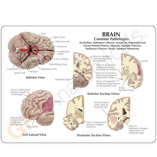 Diseased Brain in Skull Model - Part of Collection