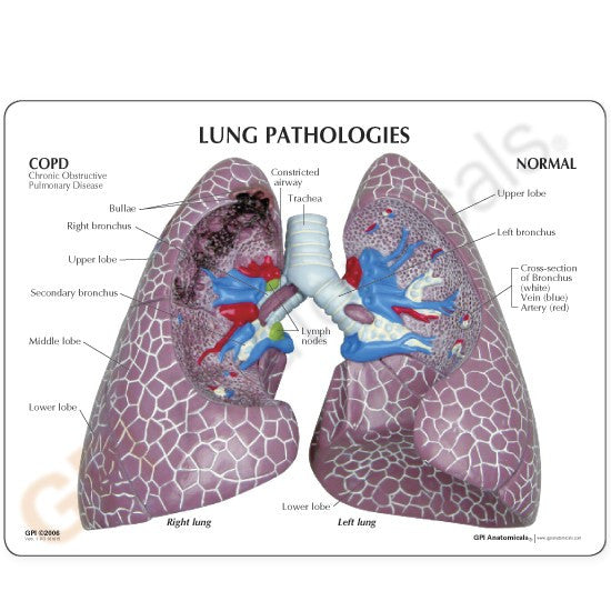 Diseased Lung Model illustrates the pathology of COPD, cancer and asthma