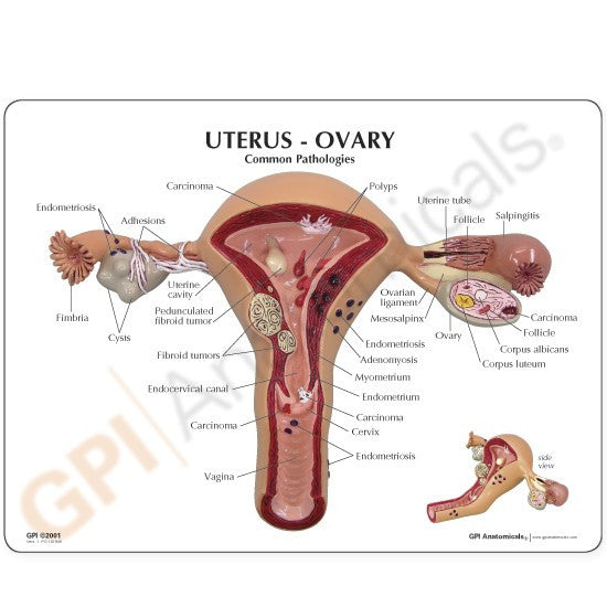 Diseased Uterus and Ovaries Model