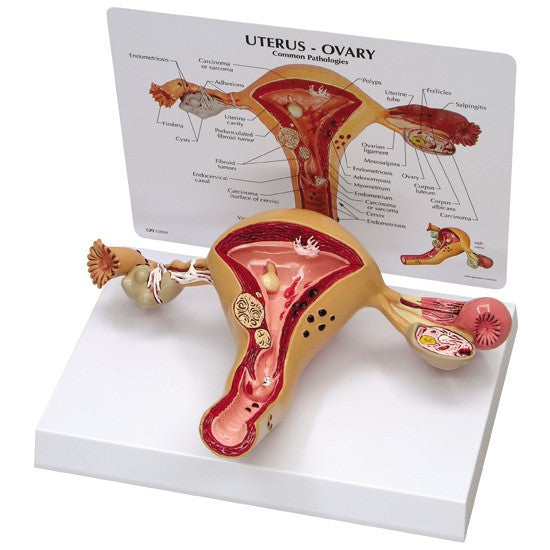 Diseased Uterus and Ovaries Model