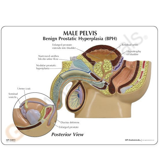 Male Pelvis Section Model with BPH Patient Education Card