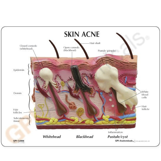 Normal / Acne Skin Model