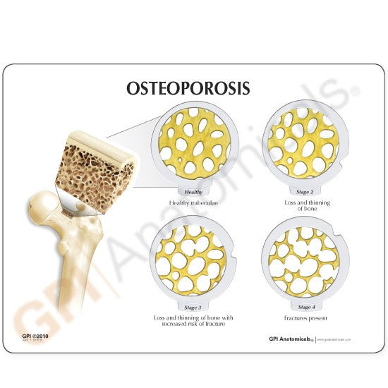 Osteoporosis Hinged Disc Set (4 Piece)