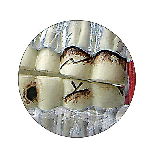 The model demonstrates the effects that TMJ dysfunction has on teeth