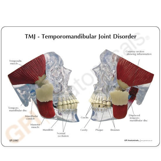 TMJ Disorder Model