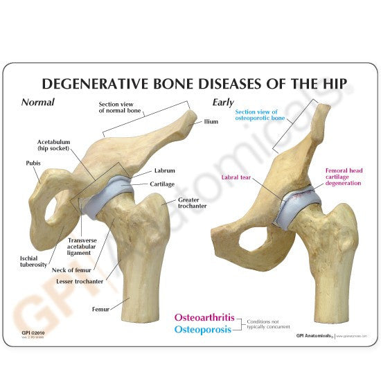 Degenerative Bone Diseases of the Hip Model (4 stages)