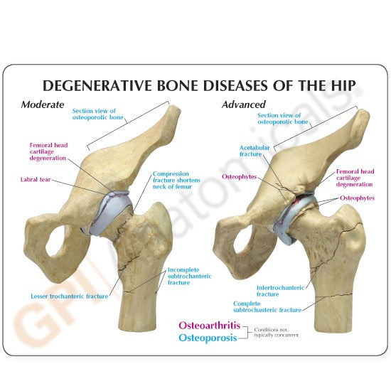 Degenerative Bone Diseases of the Hip Model (4 stages)