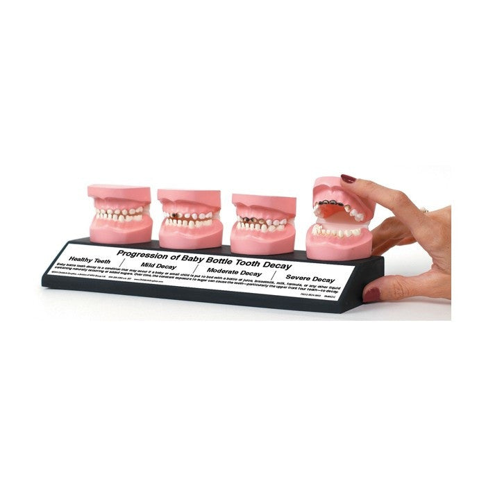 Progression Of Baby Bottle Tooth Decay Display