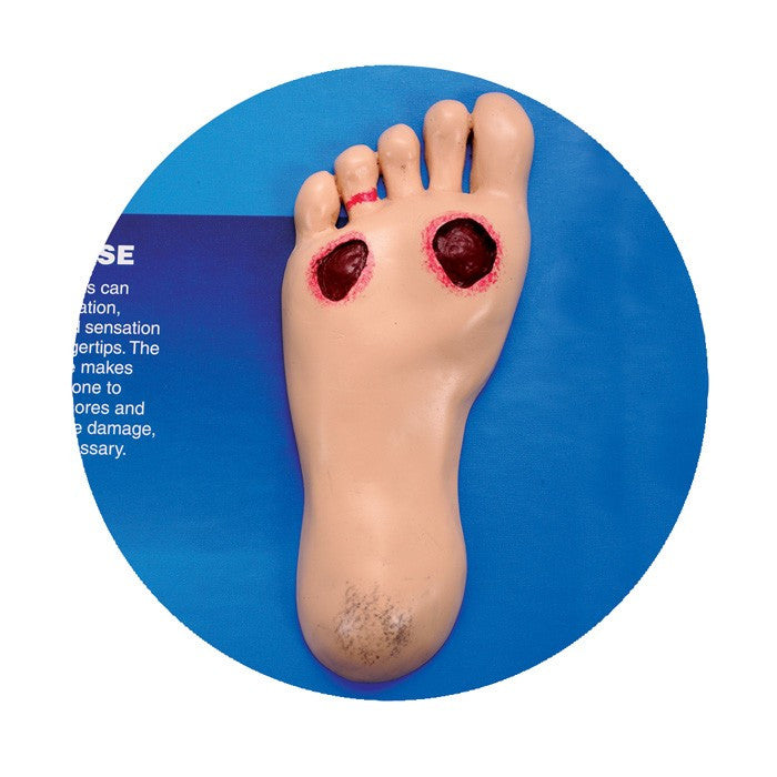 The Consequences of Diabetes 3D Display