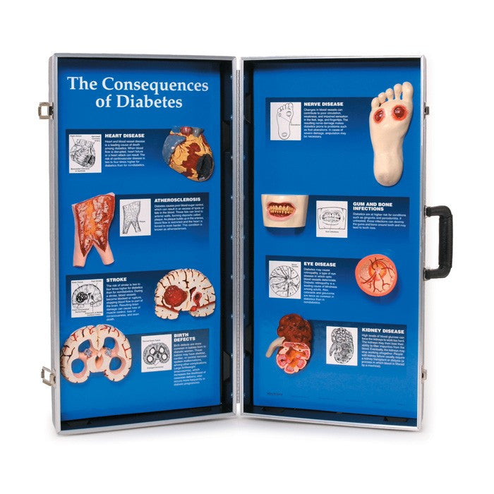 The Consequences of Diabetes 3D Display