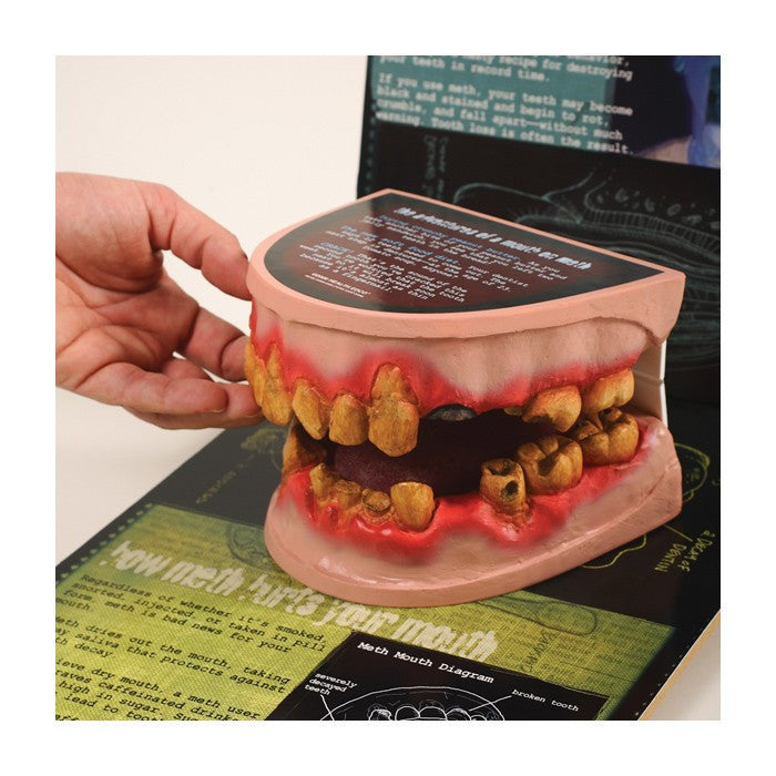 Meth Mouth: An Inside Look Display