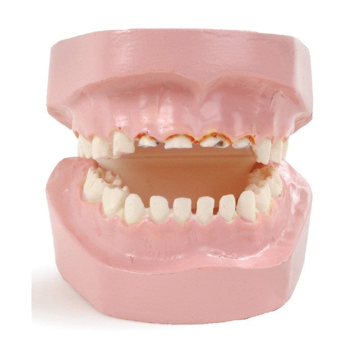 Baby Bottle Tooth Decay Model