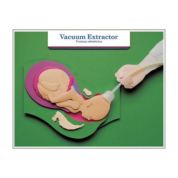 Labour and Birth Intervention Laminated Chart Set (Set of 6, English/Spanish)