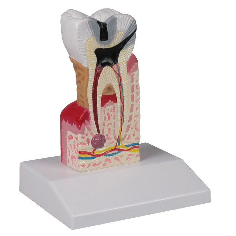 Tooth Decay Model (10 times life size)