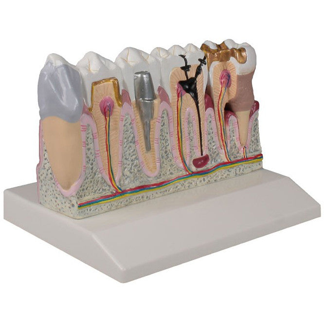 Tooth Disease Model (4 times life size)