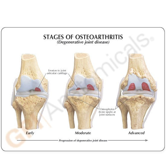 Osteoarthritis Knee Model Set (4 stages)