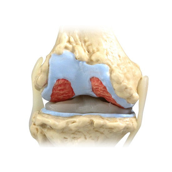 Osteoarthritis Knee Model Set (4 stages)