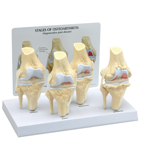 Osteoarthritis Knee Model Set (4 stages)
