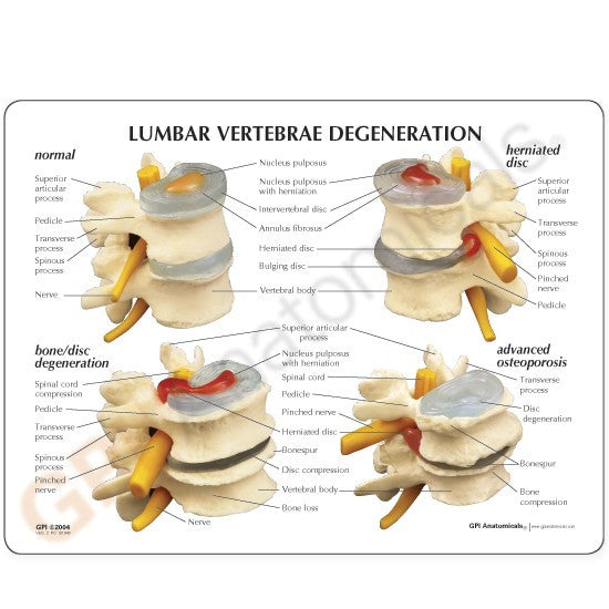 Lumbar Spine Degeneration Model Set (4 stages)
