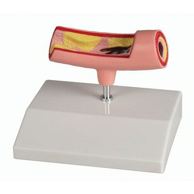 Artery with Thrombus Model