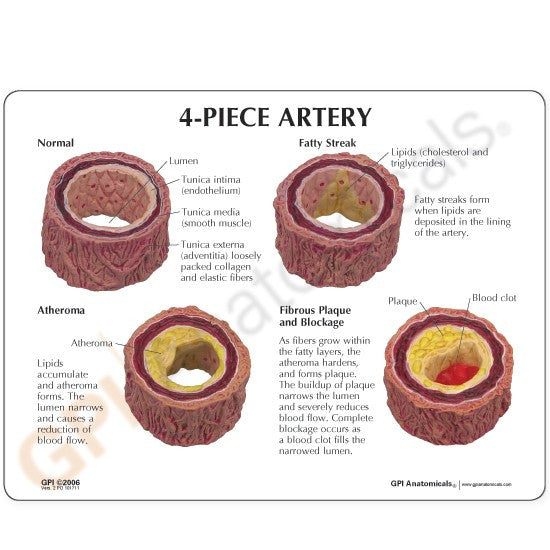 Atherosclerosis Artery Model