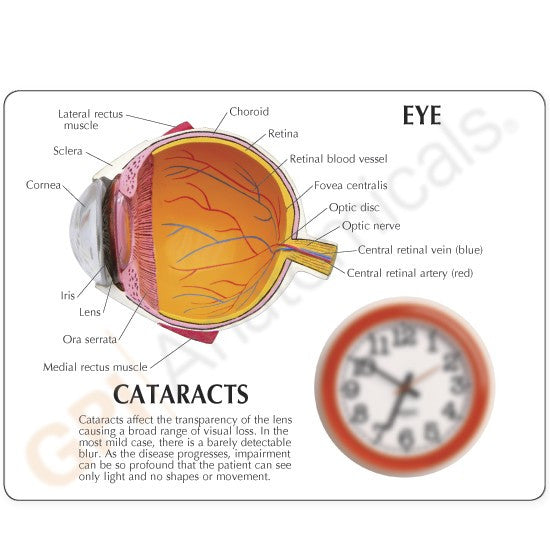Cataract Eye Model - Part of Collection