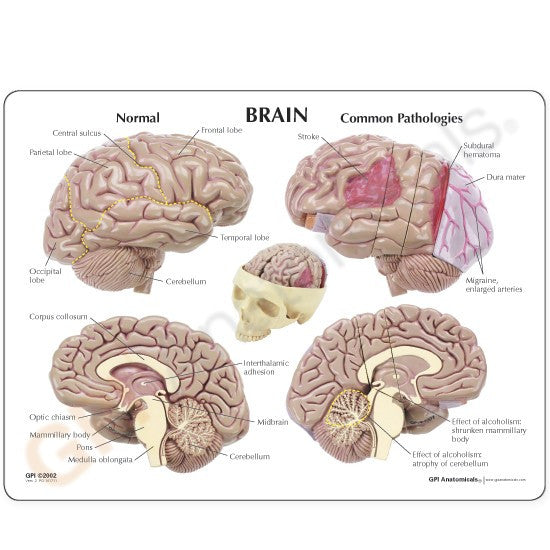 Model shows various pathologies such as Alzheimer's, tumours, MS, Parkinson's disease and stroke