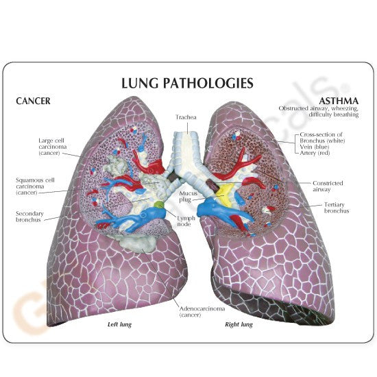 Model with education card shows the anatomy of diseased lungs