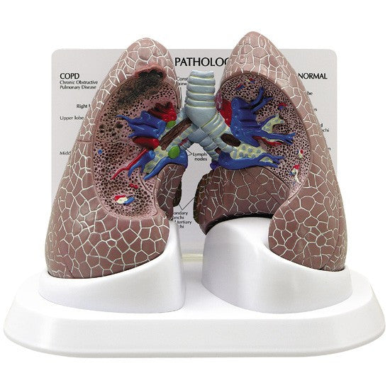 Diseased Lung Anatomy Model 3110