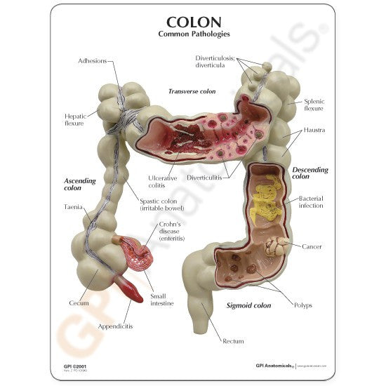 Colon Model with Common Pathologies