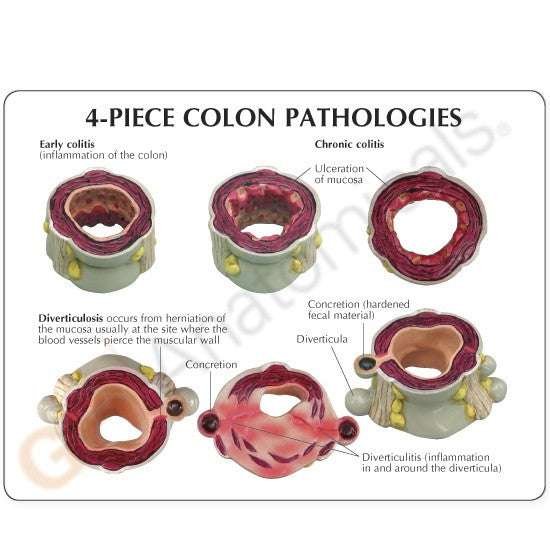 Colon Model with Pathologies (4 piece)