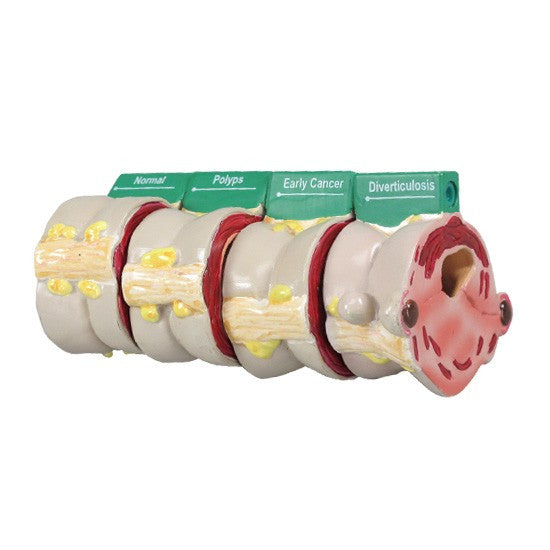 4 piece cross sectional model of the colon demonstrating various disease conditions