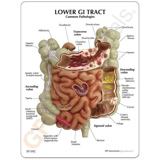 Lower GI Tract with Pathologies Model