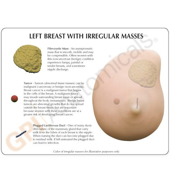 Breast Cancer Anatomical Model - Part of Collection