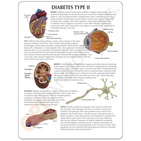 Type II Diabetes Model (8 part)