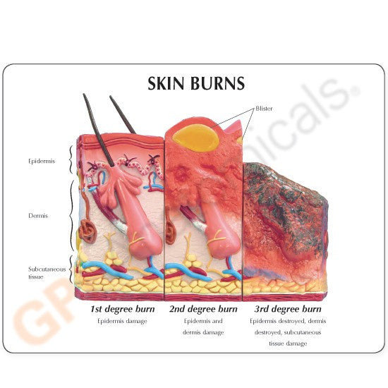 Skin Burn and Normal Skin Anatomical Model