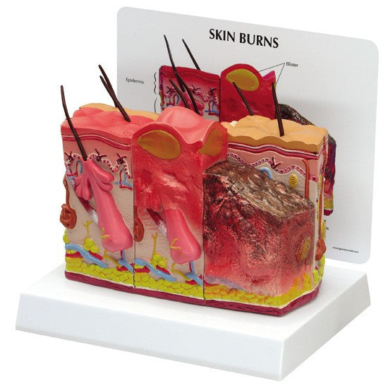 Skin Burn and Normal Skin Anatomical Model