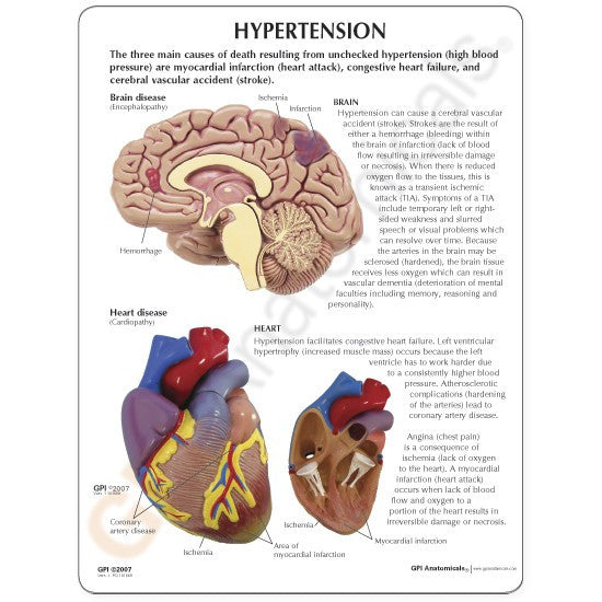 Hypertension Model Set