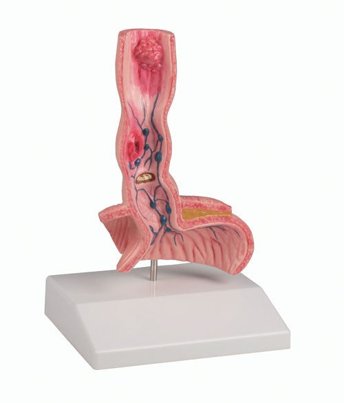 Oesophagus Diseases Model