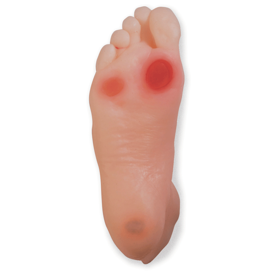 Diabetic Foot Model