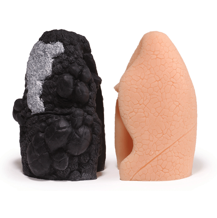 Life Or Death Lungs Model Set (2 part)
