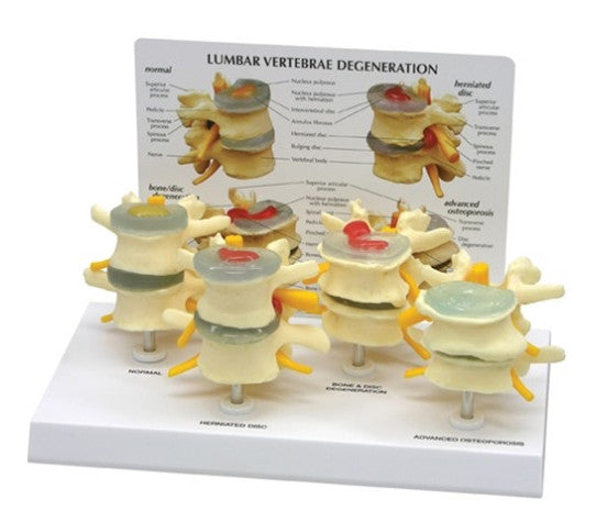 Lumbar Spine Degeneration Model Set (4 stages)