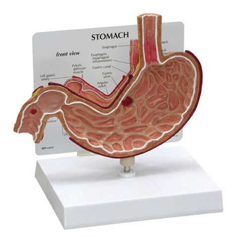Stomach Ulcer Anatomical Model