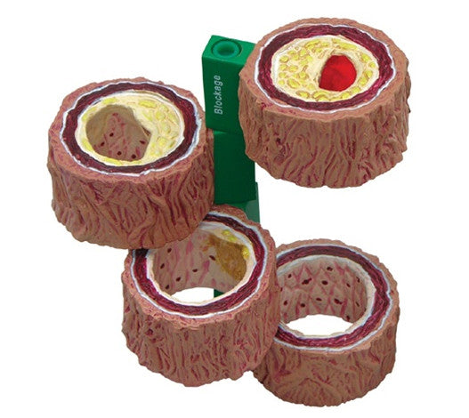 Atherosclerosis Artery Model