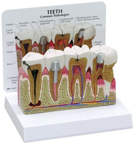 Diseased Teeth and Gums Model