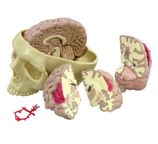 Life-size model of the brain contrasting normal and diseased anatomy