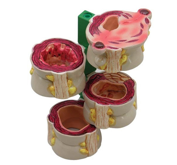 Colon Anatomical Model with Pathologies (4 piece) 3341