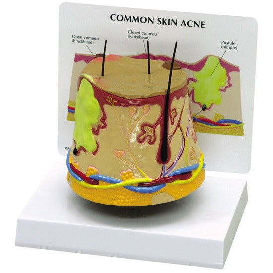 Skin Acne Model