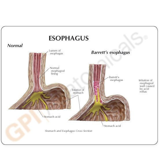 Gastro-oesophageal Reflux Disease (GERD) Model